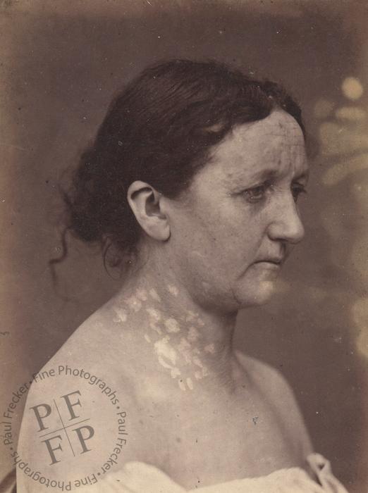 Women with syphilis 
